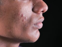 Penting untuk Kesehatan Kulit, Ketahui Mitos dan Fakta Seputar Jerawat Ini Ya!